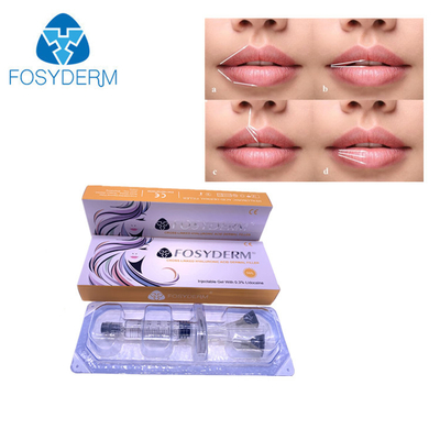 5ml Hyaluronic Acid Fosyderm  Dermal Filler Injection For Lips Nose