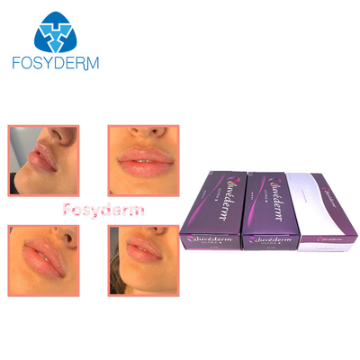 Lips Enhance Dermal Filler 2*1ml Juvederm Hyaluronic Acid Injection