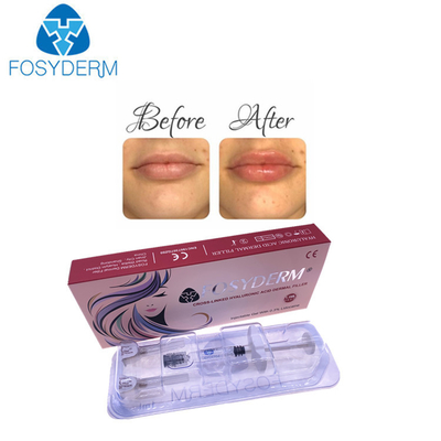 Korea Hyaluronic Acid Dermal Filler For Lip Augmentation Injection