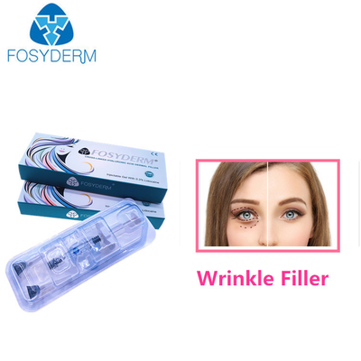 1.1 Ml Facial Injections For Wrinkles HA Dermal Filler