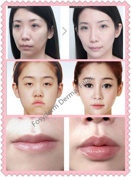 HA Injection Dermal Lip Fillers 1ml , Non Surgical Lip Augmentation Filler