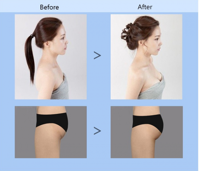 Injection Dermal Fillers For Buttocks , Non Surgical Buttock