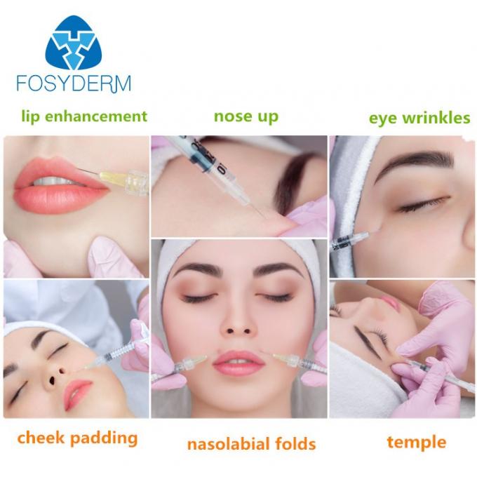 Fosyderm 2ml Lip Enhancement Injectable Dermal Fillers Hyaluronic Acid ...