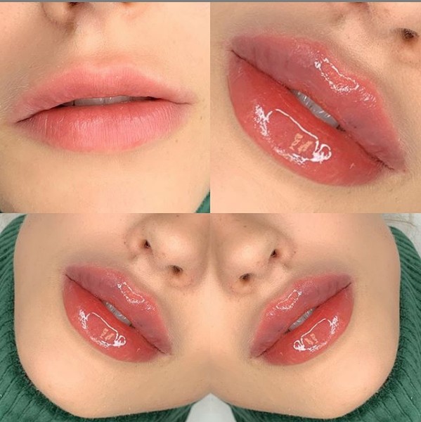 Juvederm Ultra3 2*1ml Hyaluronic Acid Dermal Filler Injection For Lips