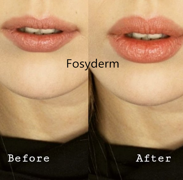 2ml Hyaluronate Acid Gel For Lips Enhancement , Hyaluronic Acid