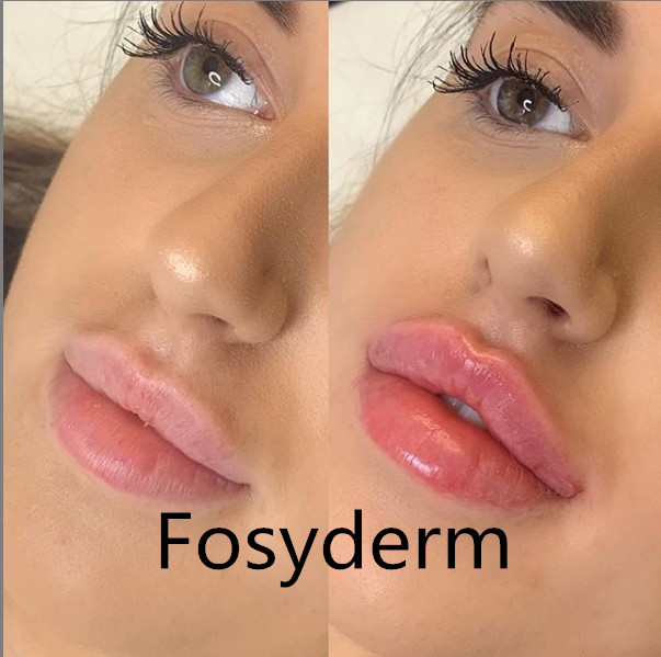 Cross Linked HA Facial 2ml Injectable Dermal Filler Hyaluronic Acid