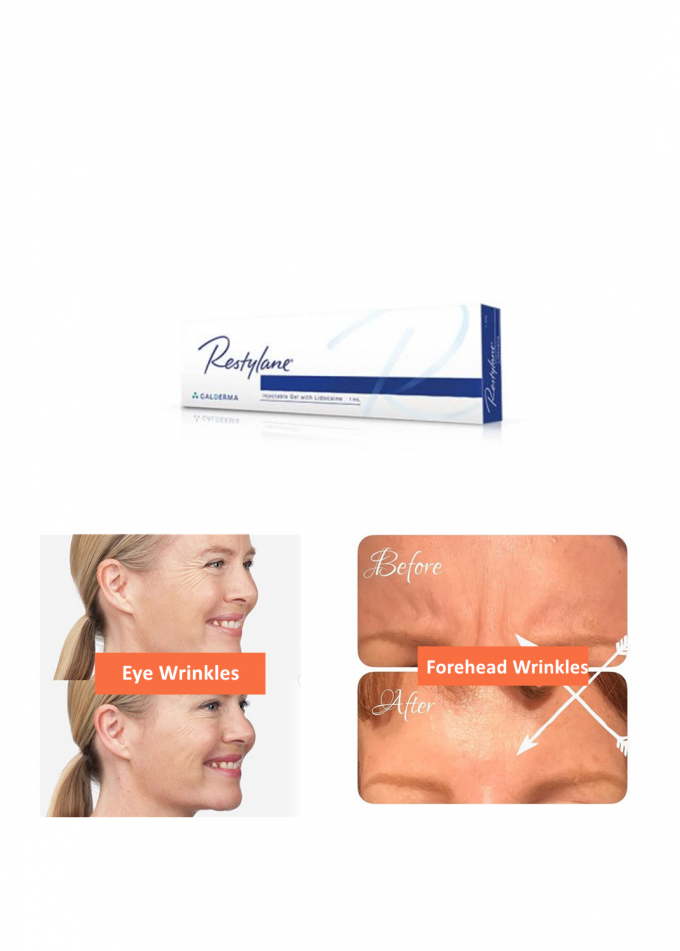 Lidocaine Hyaluronic Acid Dermal Filler Gel CE Approved