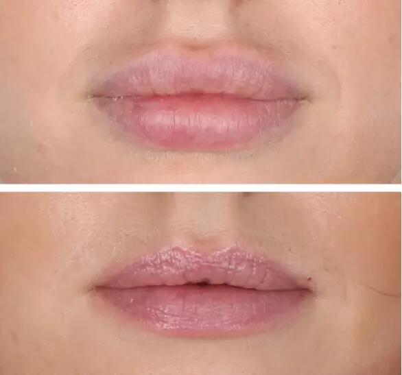 Liporase Hyaluronidase Hyaluronic Acid Lyase Dissolve Filler