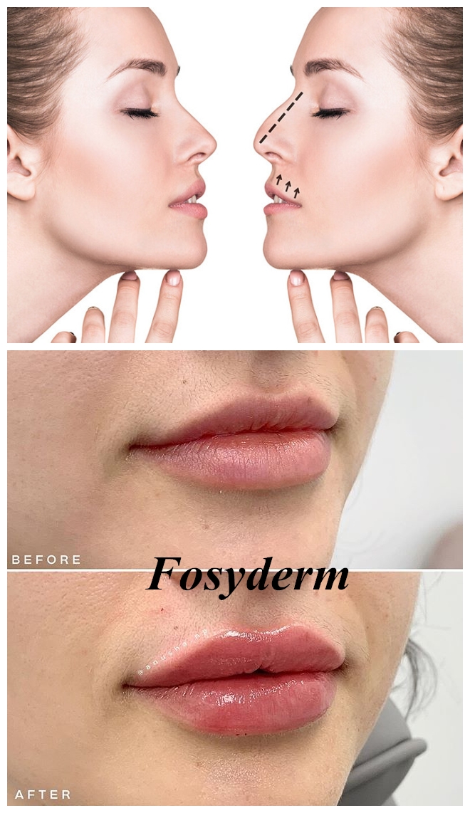 Calcium Hyaluronic Acid Injectable Dermal Filler For Facial Plastic