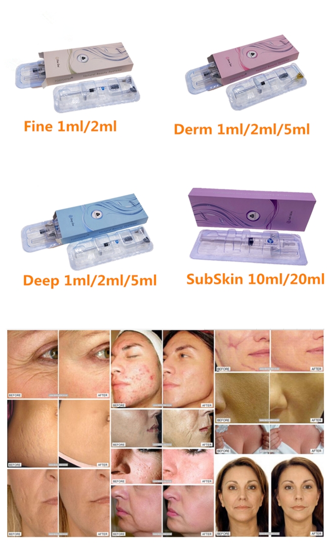 Chin Nose Up 2ml Hyaluronic Acid Dermal Filler With Lidocaine