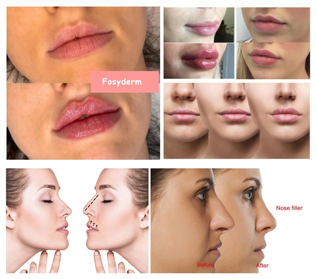 Liquid Hyaluronic Acid Dermal Filler Facial Plastic Revolax