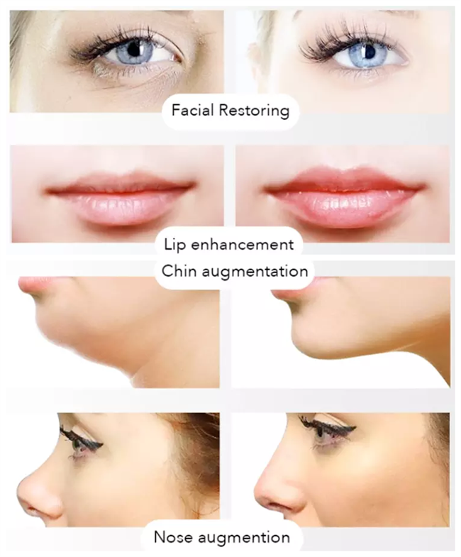 Revolax Injectable HA Dermal Filler Hyaluronic Acid Lip Enhancement