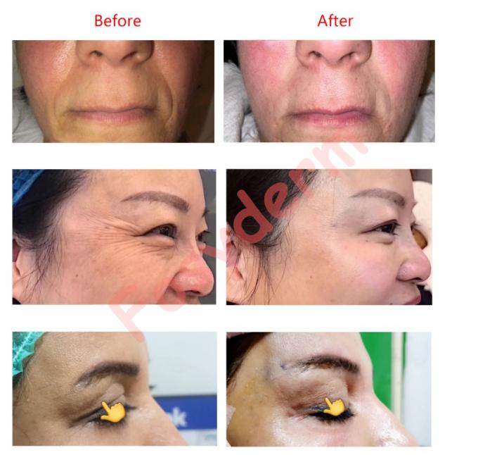 26G 27G Medical Mono PDO Thread Lift Skin Tightening PDO Thread Lift Lips