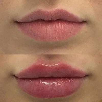 Juvederm Hyaluronic Acid Injection Dermal Filler For Face Korean Filler 0