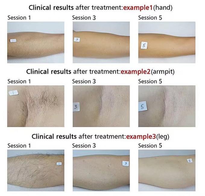 Permanent Hair Removal Laser 4k Screen 808nm Diode Laser Hair Removal Machine 2