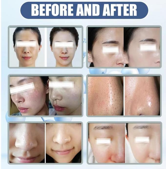 Best Care Facial Home Microdermabrasion Machine 2024 Beauty Equipment 6