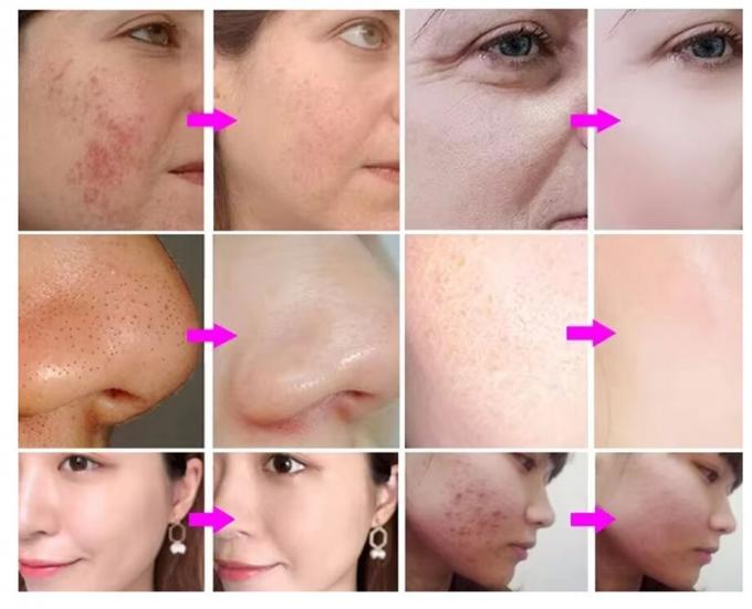 Hydra Peeling Facial hydro Small Bubble Water Hydro Aqua Facial h2o2 Hydra Machine 2