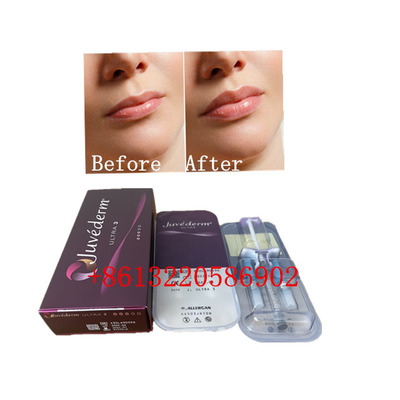 Ultra3 Juvederm Lip Filler Injection 2ml Hyaluronic Acid Dermal