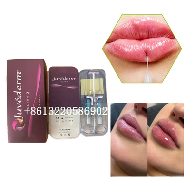 Ultra3 Juvederm Lip Filler Injection 2ml Hyaluronic Acid Dermal