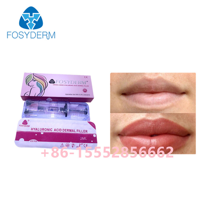 2ml Fosyderm Dermal Filler Hyaluronic Acid For Lips Enhancement