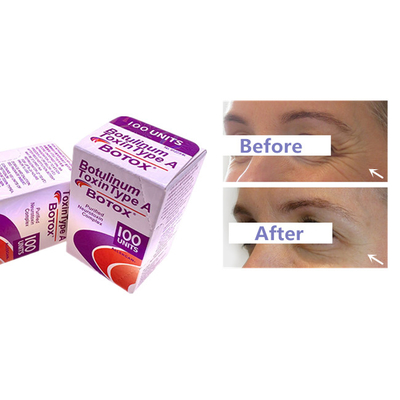 Botulinum Toxin Allergan  Injection For Wrinkle Remove