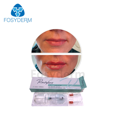  Hyaluronic Acid Dermal Filler 1ml Lip Enhancement Anti Wrinkles