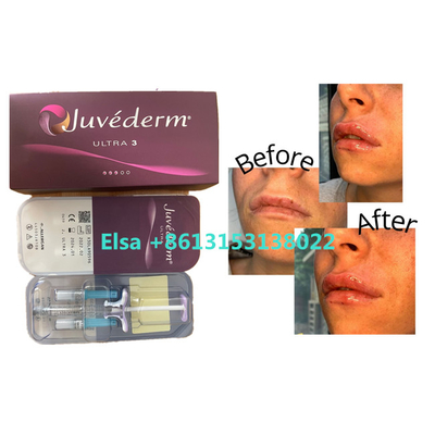 Cosmetic Products Juvederm Dermal Filler For Face Lips