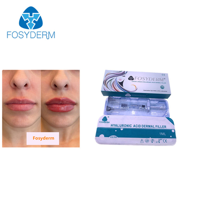 1ml Hyaluronic Acid Injection Fosyderm Dermal Filler for Lip