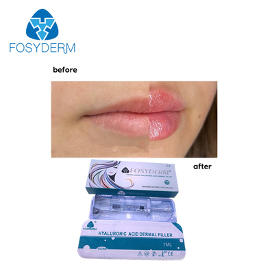 Fosyderm Dermal Lip Fillers 1ml Hyaluronic Acid Injection For Lip Enhancement