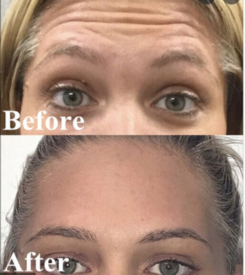 Korean Botulax  Botulinum Toxin 100 Units Wrinkles Remove