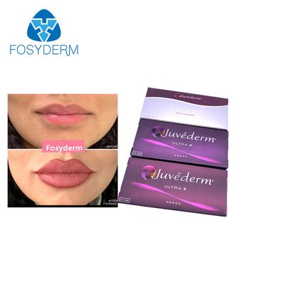 Juvederm Ultra3 Lip Enhancement Hyaluronic Acid Dermal Filler 2x1.0ml