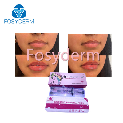 Hyaluronic Acid Injection Fosyderm Dermal Filler For Lip 2ml Cross Linked