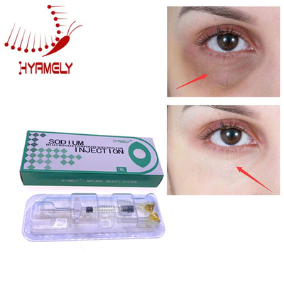 Get Rid Of Dark Circles Injecting Hyamely Filler Solution To Removing