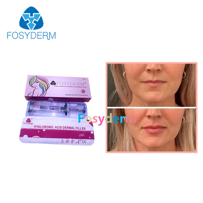 Fosyderm 2ml Dermal Lip Fillers Hyaluronic Acid Lip Enhancement Injection Derm Line