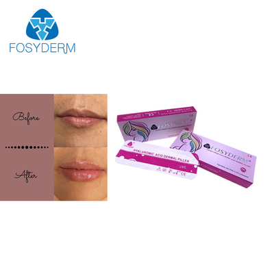 Fosyderm 2ml Dermal Lip Fillers Hyaluronic Acid Lip Enhancement Injection Derm Line