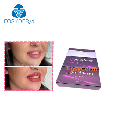 Injectable Hyaluronic Acid Dermal Filler With Natural Ingredients For Skin Rejuvenation