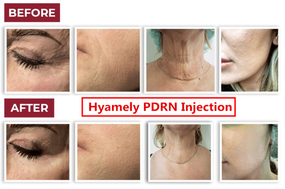 Hyamely Cell Regation Skin Booster PDRN Serum For Neck Whitening Facial Injection