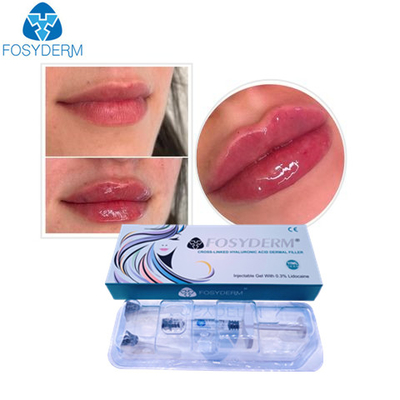 Fosyderm Hyaluronic Acid Gel Anti Facial Wrinkles Dermal Fillers Injection