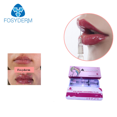 Fosyderm Cross Linked Hyaluronic Acid Dermal Filler For Skin Rejuvenation