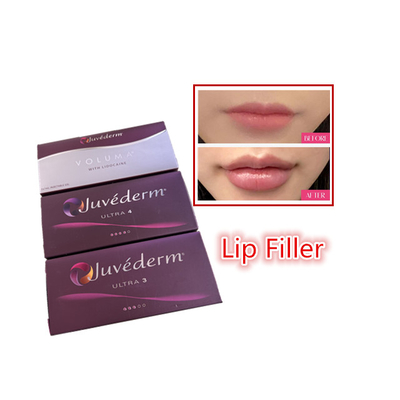 2 Ml Acid Hyaluronic Cross Linked Dermal Filler Juvederm Lip Filler Injections