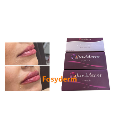 Juvederm 2*1ml Hyaluronic Acid Dermal Filler Lips Enhancement Chin Augmentation