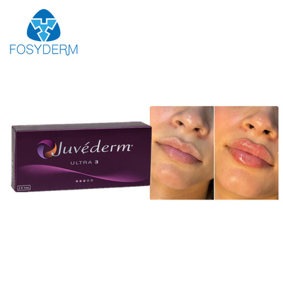 Juvederm 2*1ml Hyaluronic Acid Dermal Filler Lips Enhancement Chin Augmentation