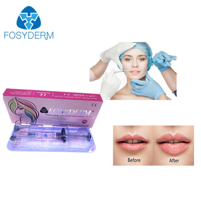 Dermal Lip Fillers Anti Aging  Lyft 1ml