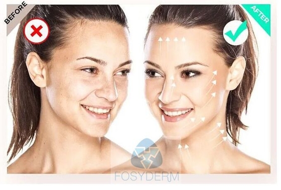 Filorga  135ha 5*3ml Face Injection Mesotherapy To Improve Skin Quality