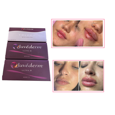 Skin Care Injections Lip Plumper Juvederm Hyaluronic Acid Dermal Filler For Face