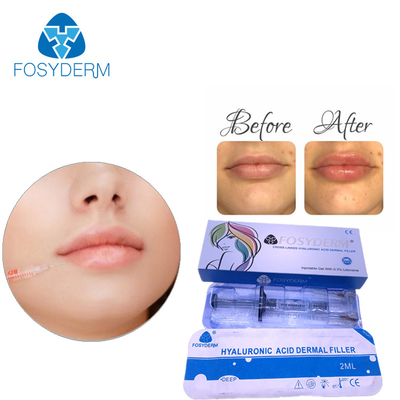 OEM Hyaluronic Acid Dermal Filler for Plump and Radiant Skin