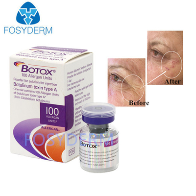 Type A 100 Units Allergan Botulinum Toxin Dermal Filler Hyaluronic Acid