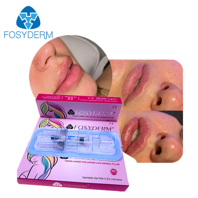 Facial Rejuvenation HA Dermal Filler for Face Chin Cheek Lips Body Beast Buttock