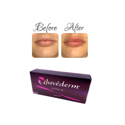 Juvederm Hyaluronic Acid Dermal Filler for Lip Facial Wrinkle