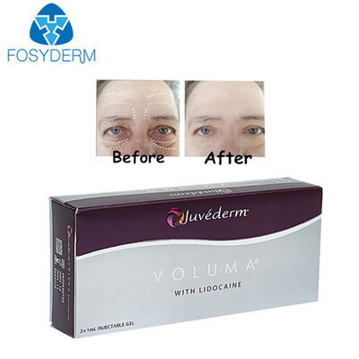 Juvederm Voluma Hyaluroic Acid Dermal Filler 2*1ml 24mg